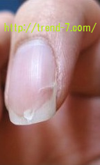 爪が縦 横に割れる 皮膚科の先生に聞いた意外な対策とは トレンドニュース7